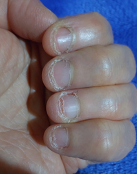 彼氏が爪を噛むのをやめません 助けてください 27歳にもなって未だに爪 Yahoo 知恵袋