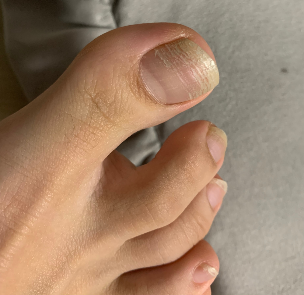 ネイリストの方に質問です このような爪の状態でジェルネイルの施術をし Yahoo 知恵袋