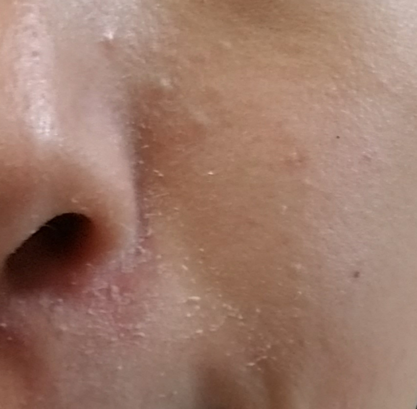 写真あります。 花粉症で鼻をかみすぎ、皮がポロポロ向けててきました。こんなにむけてしまったらファンデも浮いて大変です。どうすればいいでしょうか。 またこれはティッシュのせいですが顔の他の所もこん...