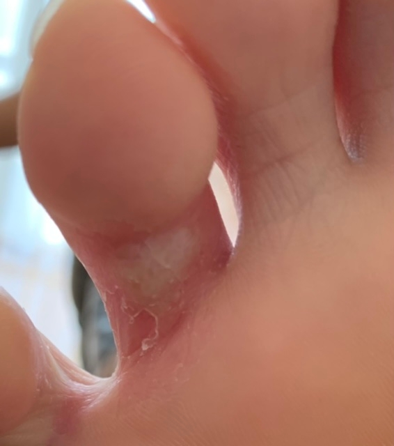【画像添付あり】 右足薬指間に水虫の様な症状があります。 症状が出始め5日ほど経ちます。 カサつき、少しの痒みがあります。 症状3日目より市販されている“ピロエースW軟膏”を朝夜と塗り始めました。 翌