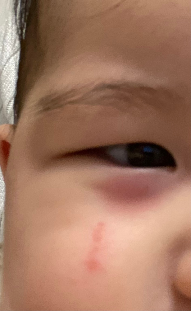 6ヶ月の赤ちゃんがいるのですが 昨日の朝起きると下瞼が赤くなっていました くま Yahoo 知恵袋