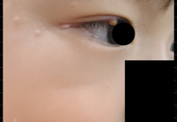 子供の目の際にあるできものについて 3歳9ヶ月になる息子ですが、2年前から全身の水イボに悩まされ、1年前に顔面(特に目の周り)に広がり、同時に目の際にも出来物ができてしまいました。小児科皮膚科では目の周りに水イボがあるため目の際の出来物も「水イボ」でしょうと言われたのですが、眼科では「水イボっぽくはないけど..」と言われ5軒ほど病院にいっていますが特定されず様子見ましょうとどこでも言われます...