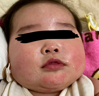 生後5ヶ月の息子がいます 乳児湿疹 よだれかぶれで小児科でクロベタゾン酪酸エス Yahoo 知恵袋