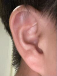 柔道をしていて数日前耳を打ってしまい内出血してしまいました それから日が経つに Yahoo 知恵袋