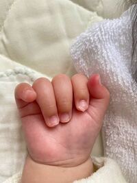 爪が剥がれかけている 生後3ヶ月の娘の爪切りをしようとしたら 右手の人差し Yahoo 知恵袋