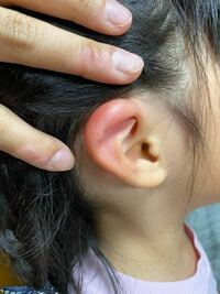 4歳の子の耳の上の部分が腫れてます 虫にさされた痕はないようにも思います Yahoo 知恵袋