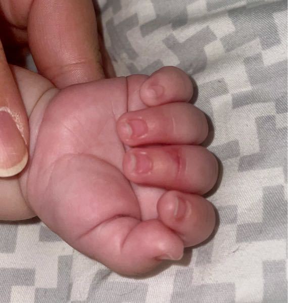 緊急です、 3ヶ月の娘の指を踏んでしまいました。 抱き上げて少ししたら寝ましたが 踏んでしまった指を見たら内出血ぽいのが出来ていました。 指は、自分でも動かすし動かしても起きたり泣いたりしません。 受
