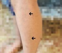 30歳なんですけどふくらはぎというかスネの辺りの血管が1部青く透けて Yahoo 知恵袋