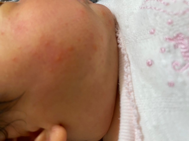 皮膚の病気 アトピー 投票受付中の質問 Yahoo 知恵袋