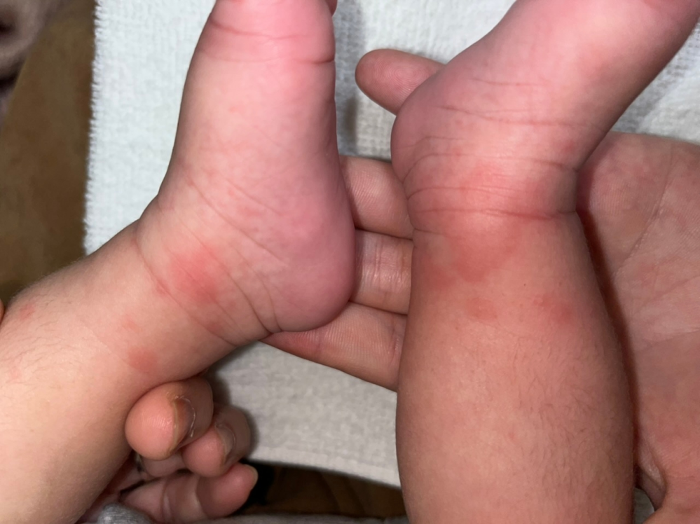 生後1ヶ月になる赤ちゃんなのですが、足と顎付近に乳児湿疹とは違う感じの出来物みたいなのができてるのですが、これは何か虫に噛まれたのでしょうか？それとも何か病気か何かでしょうか？？ 分かる方宜しくお願いします、
