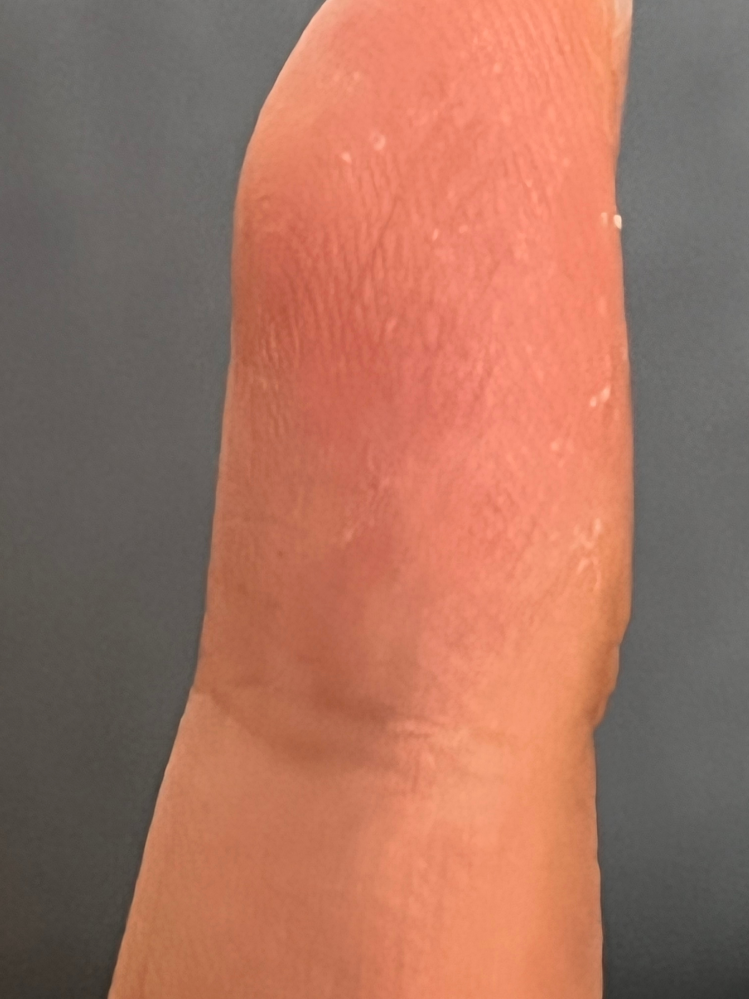 これは手の水虫でしょうか……かゆいです 小指です、