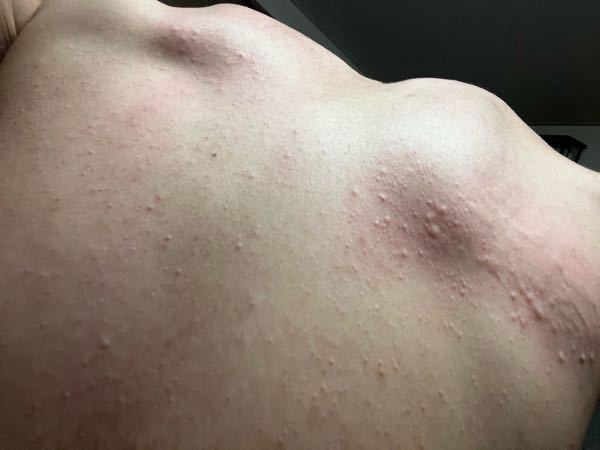 背中がひどく痒くてこんな感じなんですけど これって蕁麻疹ですか あせ Yahoo 知恵袋