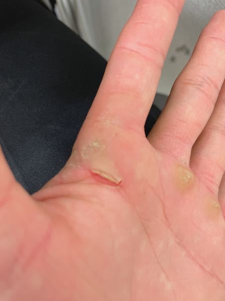 野球をしてるのですが 練習中に手の甲の人差し指の付け根あたりの皮が剥けてしまい Yahoo 知恵袋