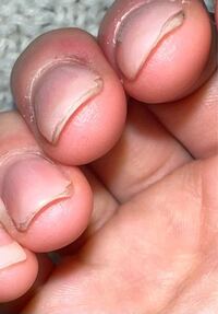 職業は飲食店で皿洗いなどあり爪に負担がよくかかりますが このように負担がかかり Yahoo 知恵袋