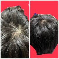 大至急つむじが禿げてきてます前髪の髪の毛も薄いです 元々髪の毛が細く Yahoo 知恵袋