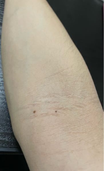 腕の内側の線の汚れが気になります。 皮膚科に通う以外でどのような治療法がありますか？