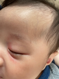 2ヶ月の赤ちゃんなんですけど 目の周りが赤いのが気になります カサカサしてたり Yahoo 知恵袋