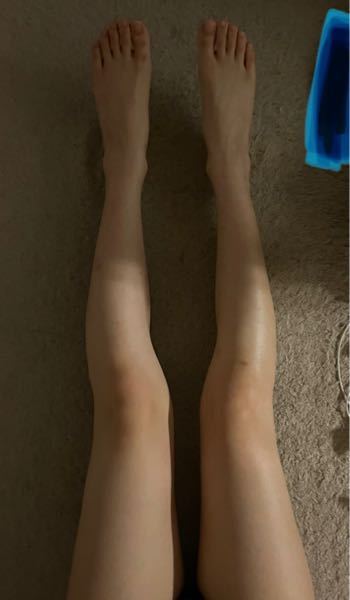 この足はXO脚ですか？ 膝から骨が(？)ぐにゃっと外側に曲がっているのが気になります。 汚い足ですみません。 (足が短い、太いのはコンプレックスなので触れないでくださいTT)