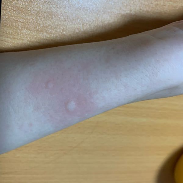 ハリネズミについての質問です。 ハリネズミを1年飼育しているのですが、 近頃お世話をした際に針が軽く腕や太ももなどの皮膚に刺さると、画像のような蕁麻疹(？)のようなものが出ます。 ずっとでは無く1時間程度で治るのですが、 痒みがあります。アレルギーなのか、針が刺さる刺激に反応しているなどあるのでしょうか。。