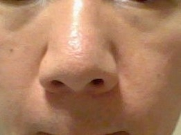 鼻の先がかっこ悪いのですが、 こういう鼻の悩みはありますか？