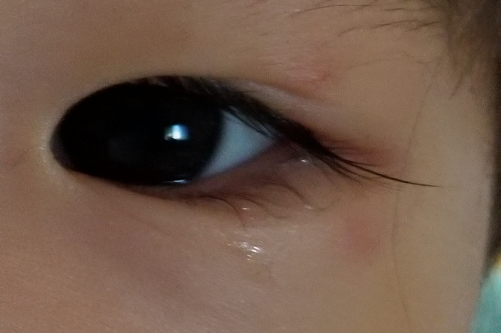 幼児の目の回りに赤い斑点が出来てしまいました。 特にかゆがったりはしません。 皮膚科を受診し、タリビット眼軟膏を処方していただき塗っていますが改善されていないように見えます。 眼科を受診したほう...