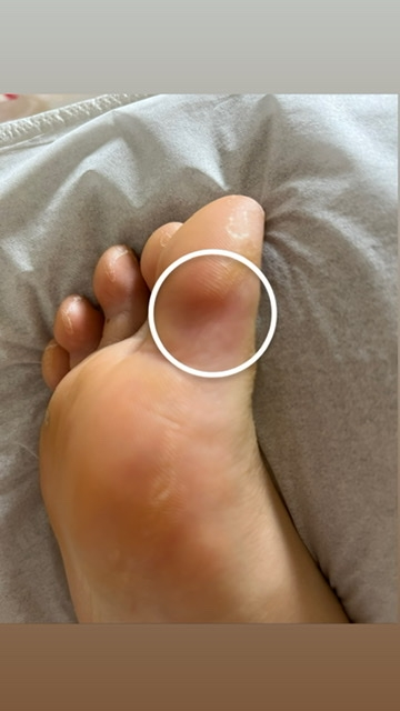 足が時々、一部赤くなり痛痒いような感覚になります。場所は大抵、足の指の付け根裏か、足の指の毛が生えるところです。これは水虫でしょうか？？