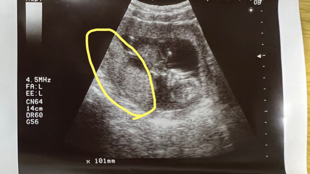 現在妊娠14週です。 ※エコー写真があります。 画像のエコーは13w4dの時のものです。黄色く囲っている箇所は胎盤の可能性がありますでしょうか？？妊婦健診の時、先生に聞きそびれてしまって…