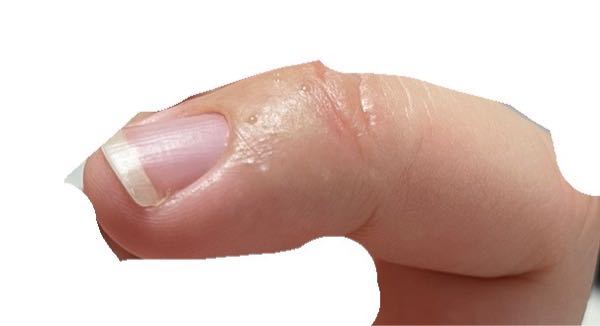 左手の薬指の爪の下部分が若干腫れ、湿疹ができ、その湿疹から透明な液体が出てきます。痒みもあります。これらの症状が無い日もあります。今は３日に1回くらいのペースで症状が出ています。他の指は何ともあ...