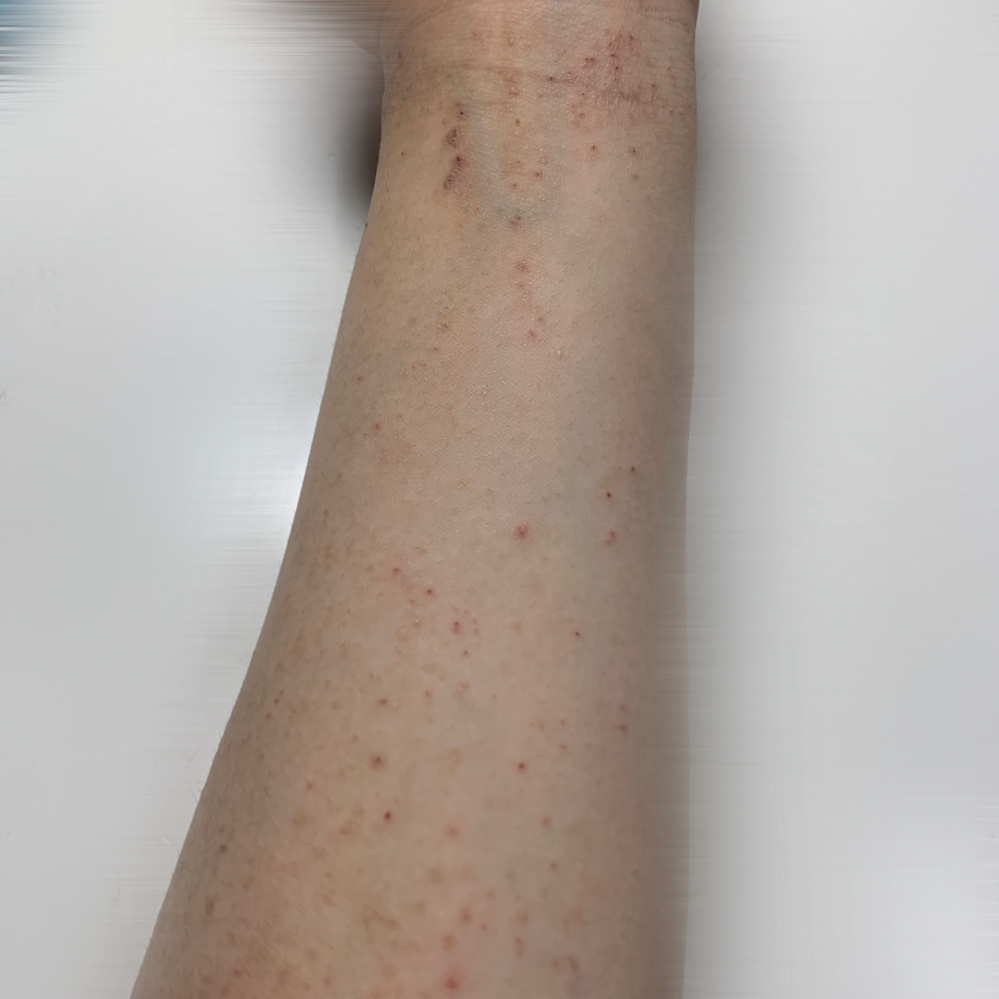 ※【腕が荒れてる写真ありなので苦手な方はご注意ください】 元々年中肌が弱くて荒れやすいのですが、腕のこのブツブツはただの湿疹でしょうか？ 近日中に皮膚科には行こうと思っているのですが、日焼け止...