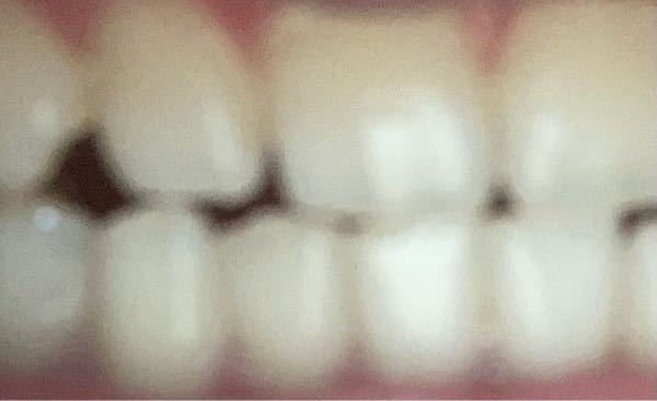 閲覧注意 この歯の黄ばみ具合はやばいですか どれくらいやばいですか