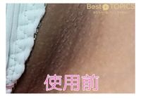 Vioの黒ずみで医療脱毛を断られることがあると聞きました Oラインはこの写真 Yahoo 知恵袋