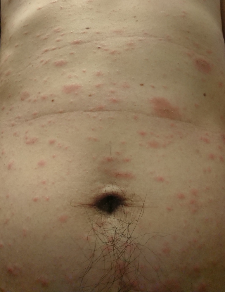 MKSAP：便秘型過敏性腸症候群/スタチン筋症/ジベルばら色粃糠疹 栃木県の総合内科医のブログ