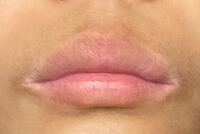 至急閲覧注意 唇がとても荒れてて色が薄くて周りが黒ずんで 口角が下がってい Yahoo 知恵袋