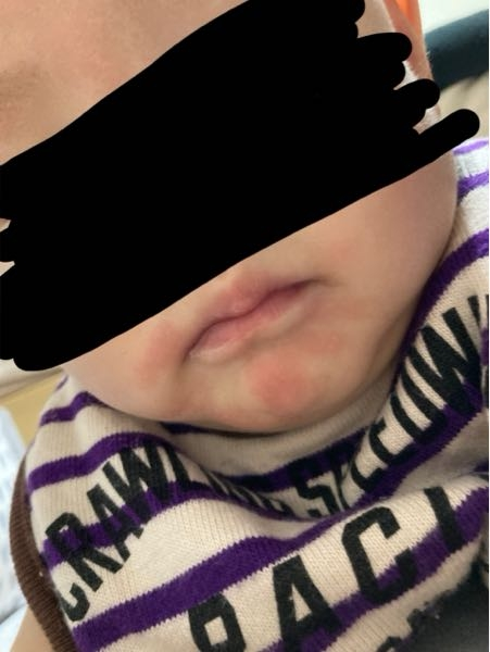 赤ちゃんのアレルギーについてなんですが アレルギーが出た時 この写真のような症状ですか？