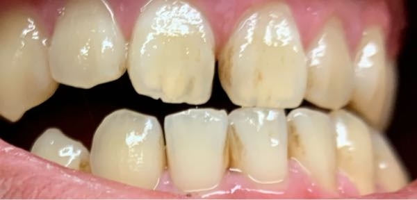 歯の隙間が特に茶色いのですがこれは虫歯とは関係ないでしょうか。ホワイトニングなどで綺麗になりますか？汚い画像ですみません。