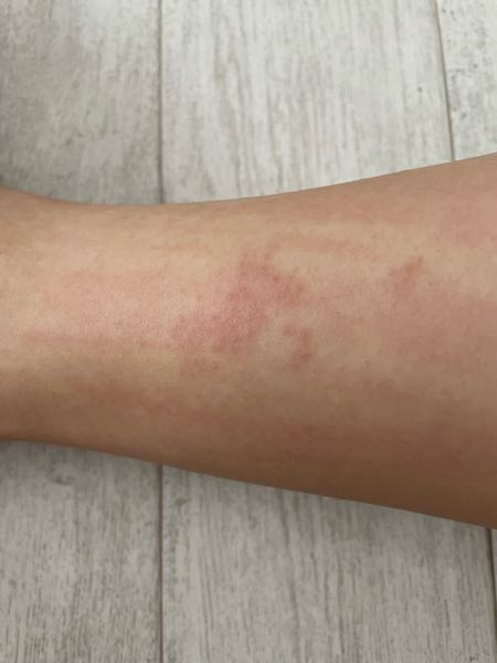 皮膚の病気 アトピー 解決済みの質問 Yahoo 知恵袋