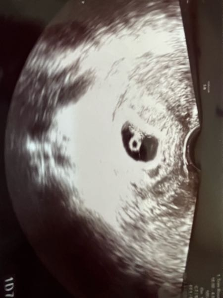 エコー写真の見方について 本日6週4日くらいで病院を受診し、胎嚢と心拍も確認できました。 受診の際に詳しく聞けなかったのですが、このエコー写真の場合どこの部分が赤ちゃんなのでしょうか？ 初めて...