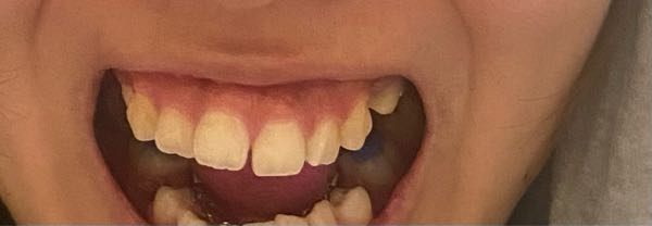 裏側矯正を始めて一ヶ月経たないくらいです。 前歯が動いているのか隙間ができました。。 個人差はあると思いますがどれくらいでくっつきますか？