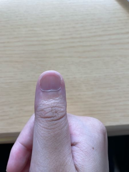 これはマムシ指でしょうか？