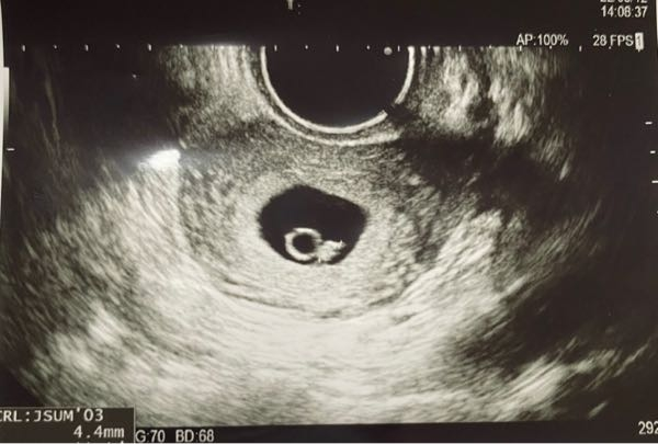 体外受精で妊娠したのですが卵黄囊が少し大きいように見えます。 6w4dで胎芽も見え心拍確認も出来ました。 卵黄囊が大きいと流産やダウン症の可能性も高くなるとネットで見て不安で仕方ないです。 下...