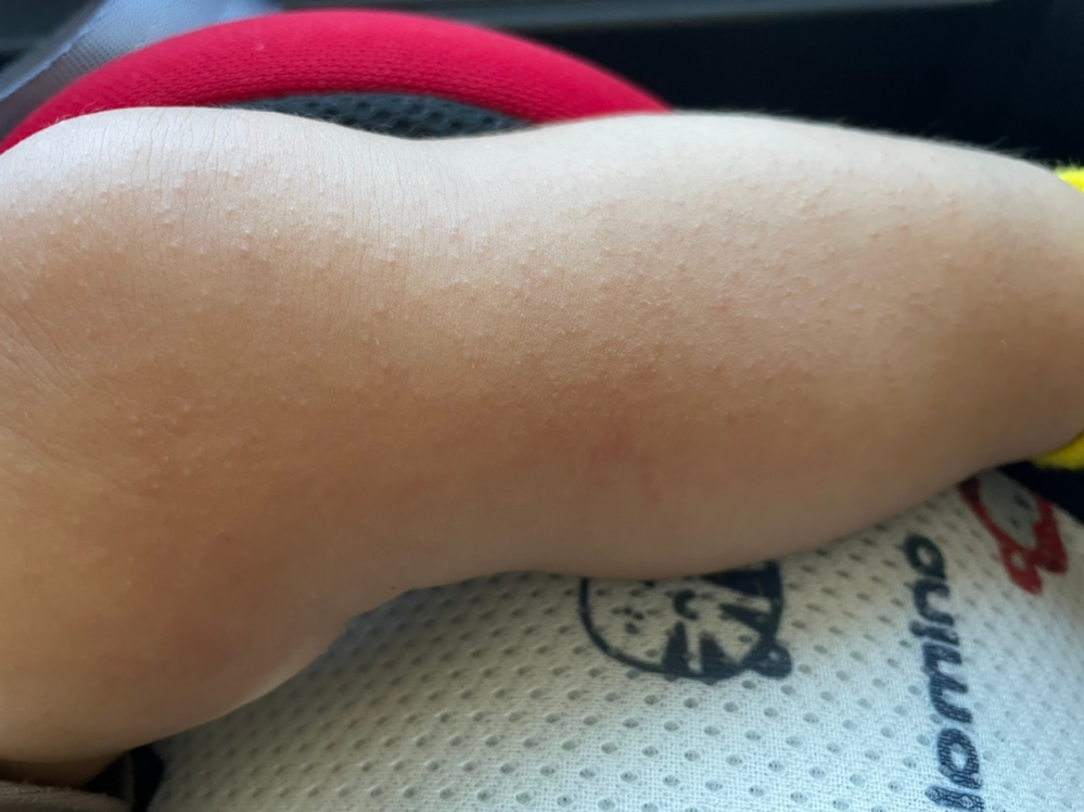 子供の湿疹について(>_<) こんばんは。 ２日程前に子供(生後８か月)が38℃の熱を出し、 １日半様子を見て熱は下がったのですが 足の太ももから足首にかけて湿疹が出来ました。 痒...