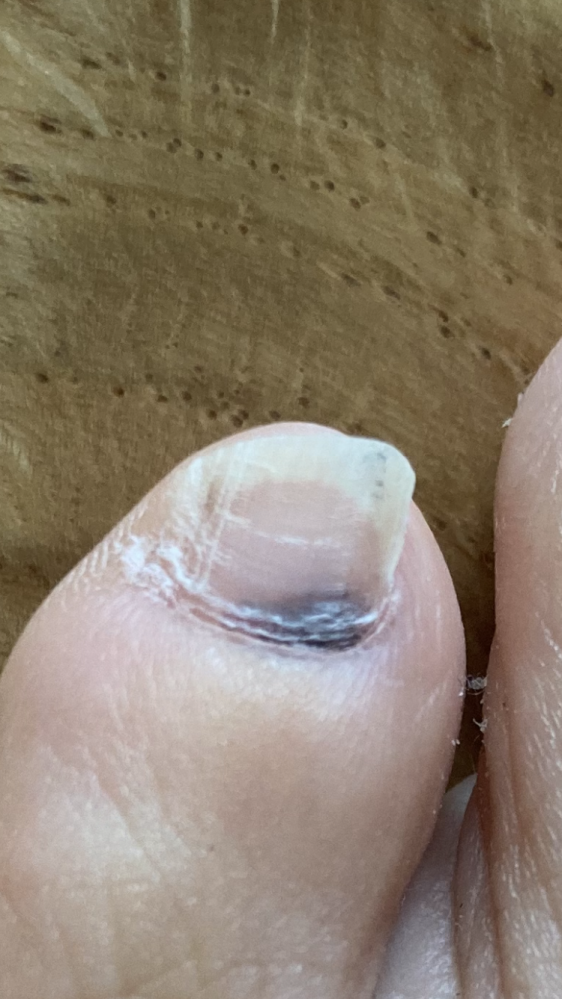 1ヶ月程前に、足の小指に黒い横線があることに気づきました しばらく様子を見ていたら大きくなっており不安です 痛みはないです 内出血でしょうか？それともメラノーマでしょうか？