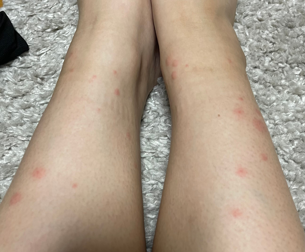 皮膚の病気 アトピー 解決済みの質問 Yahoo 知恵袋