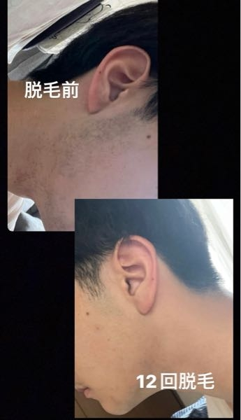 脱毛器のトリアお使いの方教えてください！！ - オークションで購入