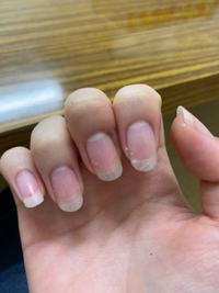 爪と皮膚がだんだん剥がれてきた閲覧ありがとうございます 画像はさっき撮った自分 Yahoo 知恵袋