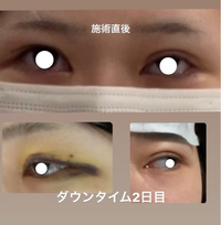 埋没失敗されました 大手クリニックで25万の埋没を受け、1回目の手術で幅広くなりすぎてしまい、１ヶ月たってもハム目で目尻と目頭に変な線も出てきてしまった為、保証が効いたので麻酔代のみで再手術を受けました。

手術すると決め、医者とカウンセリングした時も1回目はこの幅にする？と聞かれ片目の二重幅を確認されただけで、もう片方の目はシュミレーションせず施術されました。

整形が初めてだったためこの...