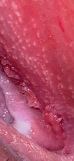 これはコンジローマですか Yahoo 知恵袋