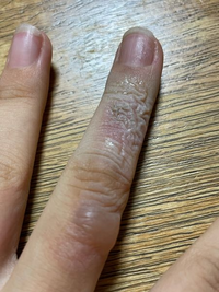 火傷しました 上が爆ぜて1日たって 下はまだはぜてません ここからど Yahoo 知恵袋