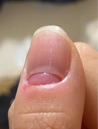 爪が根元から剥がれてしまいました...この状態から元の爪に生え変わる 