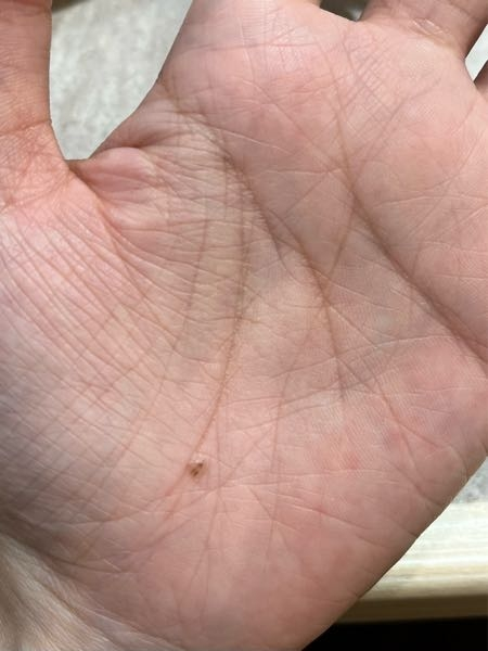 【手のほくろが消えてそう】 手のひらのほくろについて。 左手の... - 教えて！しごとの先生｜Yahoo!しごとカタログ